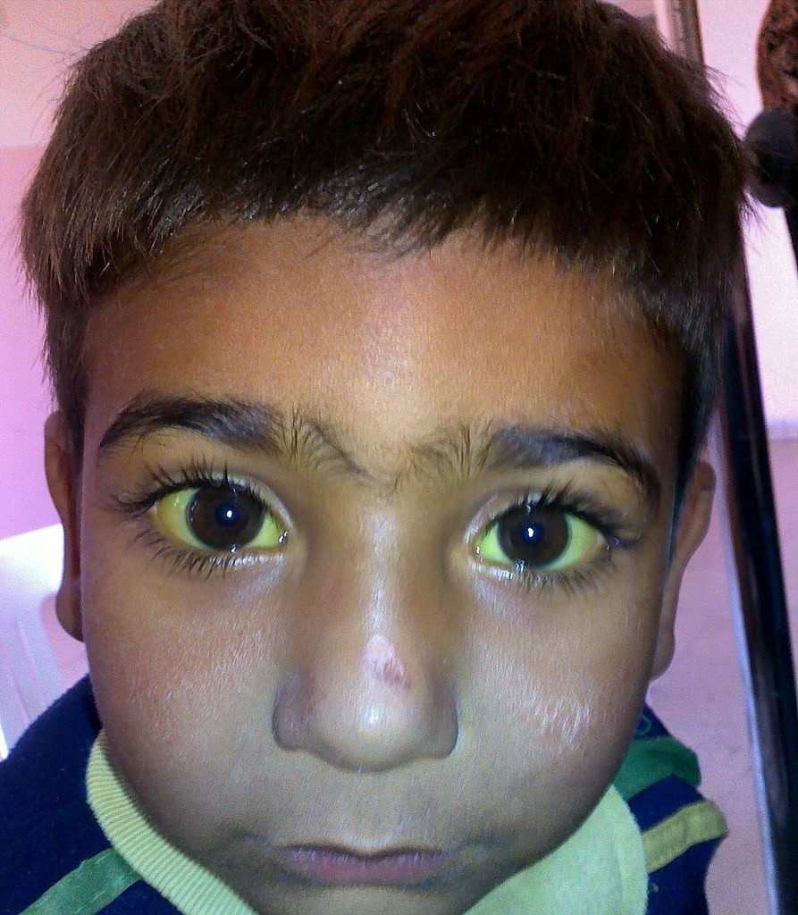 Figure 2: A four-year old boy in Jordan with jaundice (March , 2010) - Sab3el3eish on Wikipedia; CC licence